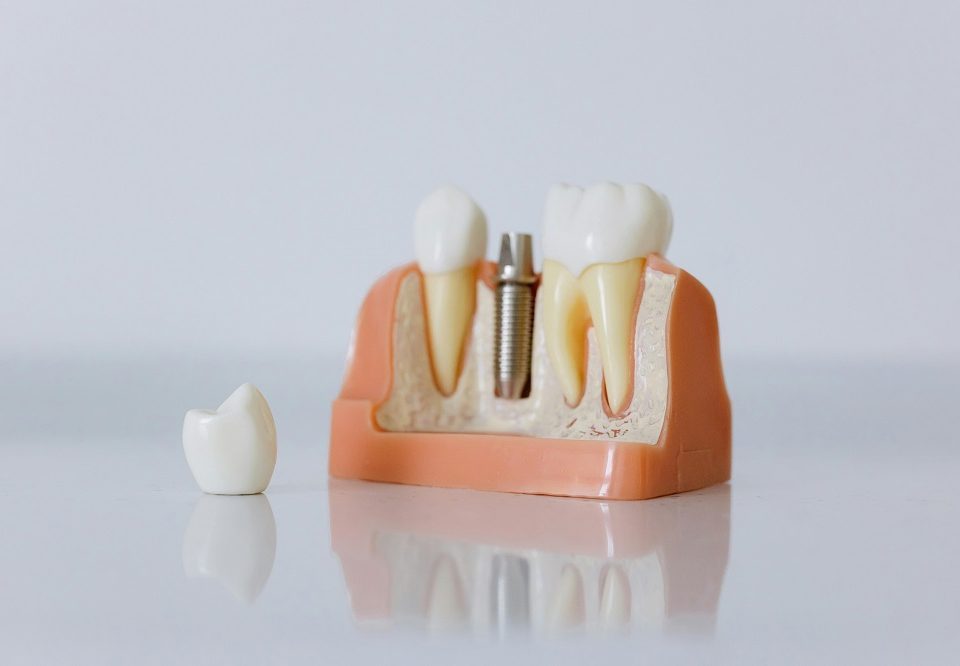 New Dental Implant Smile