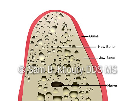 Dental Implant Basics