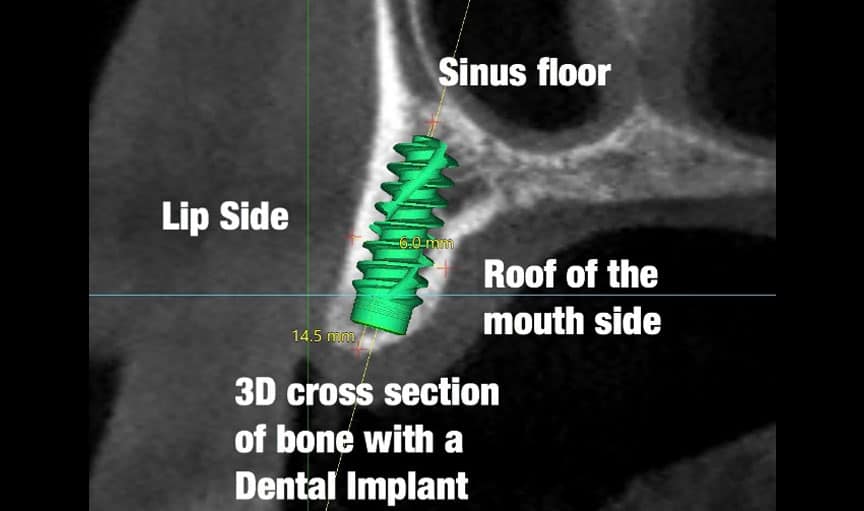 Dental CT Scan CBCT