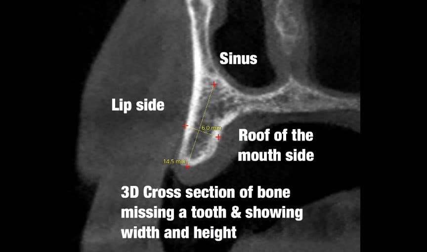 3D Data Tooth Within The Bone